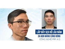 Trẻ Hóa Da PRP Trị Sẹo Rỗ