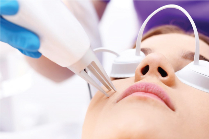 Bắn tia Laser trẻ hóa da