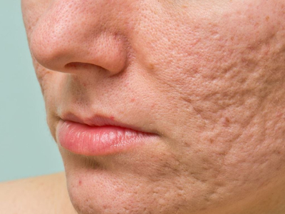 C&aacute;ch l&agrave;m đầy da bị sẹo l&otilde;m hiệu quả bằng trẻ ho&aacute; da PRP