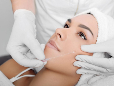 Căng chỉ trẻ h&oacute;a da mặt l&agrave; g&igrave;