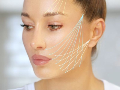 Cấy chỉ Enzyme x&oacute;a nhăn c&oacute; hiệu quả bao l&acirc;u?