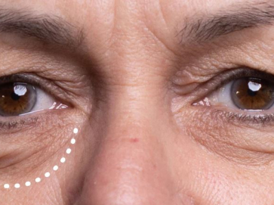 Cấy chỉ Enzyme x&oacute;a nhăn mắt tại quận 12 TPHCM