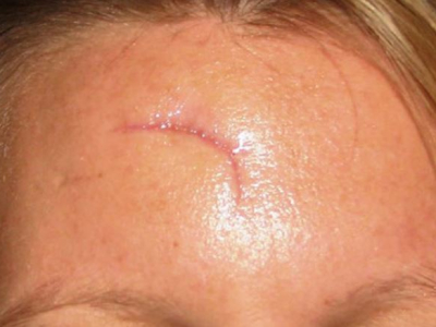 Chữa l&agrave;nh vết thương da mặt kh&ocirc;ng để lại sẹo bằng c&aacute;ch n&agrave;o?