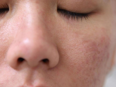 Da mặt sần s&ugrave;i phải l&agrave;m sao? Thực hiện ngay trẻ ho&aacute; PRP