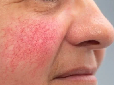 Giải Ph&aacute;p Chuy&ecirc;n Gia: C&aacute;ch Chăm S&oacute;c Da Hay Bị Ứng Đỏ Hiệu Quả Tại Nh&agrave;