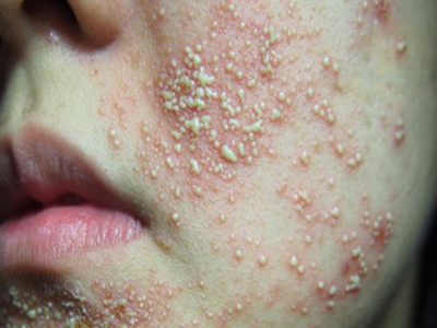 Nhận Biết Da Bị Nhiễm Corticoid: Dấu Hiệu Nguy Hiểm V&agrave; C&aacute;ch Khắc Phục An To&agrave;n