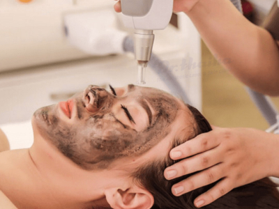 Trẻ h&oacute;a da Laser Carbon than hoạt t&iacute;nh