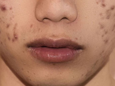 Trẻ ho&aacute; da PRP - C&aacute;ch l&agrave;m mờ giảm vết th&acirc;m da mặt hiệu quả