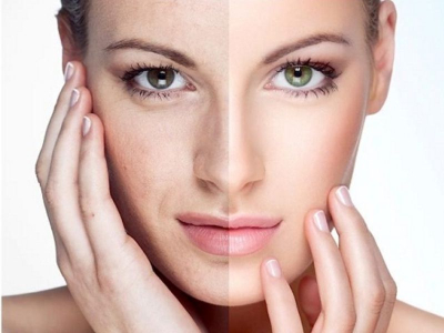 Trẻ h&oacute;a da PRP d&ugrave;ng được bao l&acirc;u, xem ngay để biết!