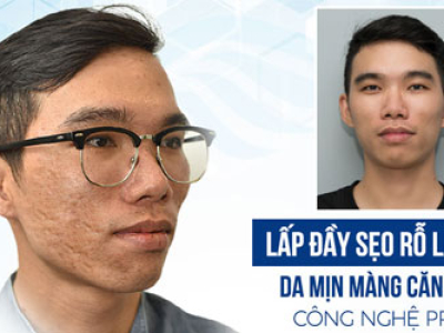 Trẻ H&oacute;a Da PRP Trị Sẹo Rỗ