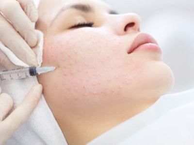 Trẻ h&oacute;a da ti&ecirc;m vi điểm