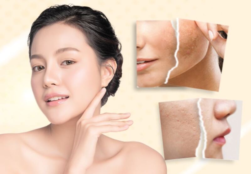 Dr Tâm giúp bạn sớm có cách chăm sóc da sau khi lăn kim trẻ hóa hiệu quả