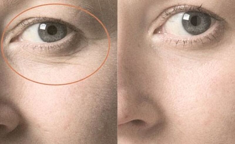 Căng chỉ trẻ hóa da vùng mắt