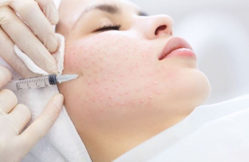 Trẻ hóa da tiêm vi điểm